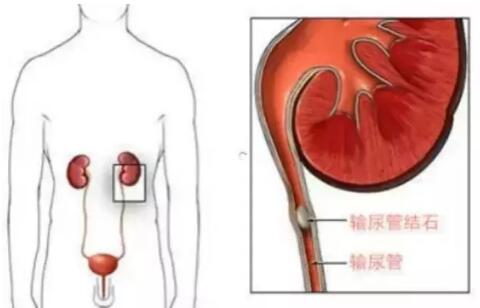 輸尿管結(jié)石，到底能不能保守治療？