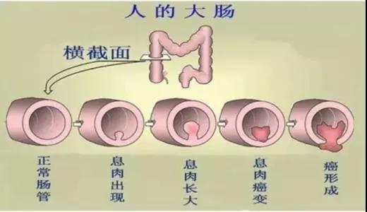 體檢發(fā)現(xiàn)腸息肉會(huì)癌變嗎？